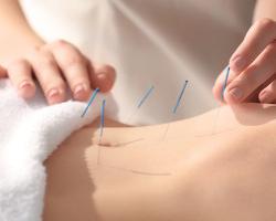 Does Acupuncture Improve The Success Of IVF?